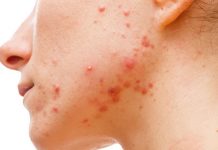 MASKNE – Cómo puedo evitar el acné mecánico por el uso de mascarillas? MASKNE - Cómo puedo evitar el acné mecánico por el uso de mascarillas?