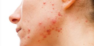 MASKNE – Cómo puedo evitar el acné mecánico por el uso de mascarillas? MASKNE - Cómo puedo evitar el acné mecánico por el uso de mascarillas?