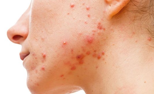 MASKNE – Cómo puedo evitar el acné mecánico por el uso de mascarillas? MASKNE - Cómo puedo evitar el acné mecánico por el uso de mascarillas?